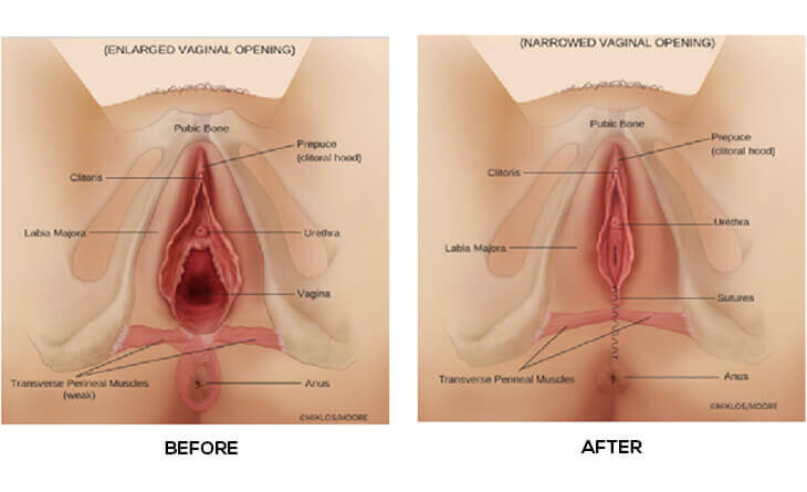 10-Most-Common-Questions-About-Vaginal-Tightening-Surgery-Dr-Priya-Bansal-24