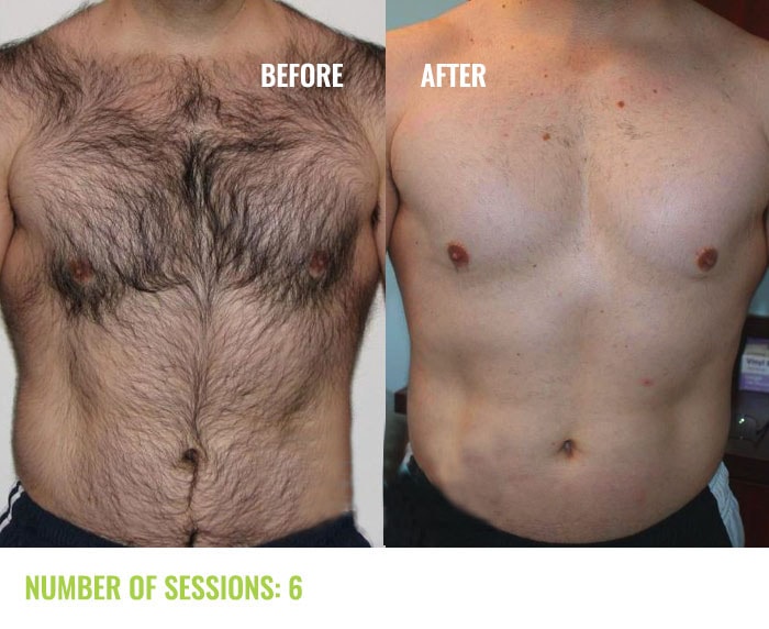 Laser4less-Men-Chest-2-laser-hair-removal-min