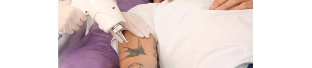 Tattoo Removal