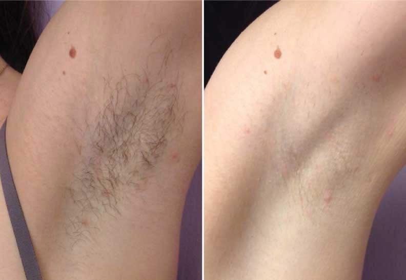 hair-removal-before-after2