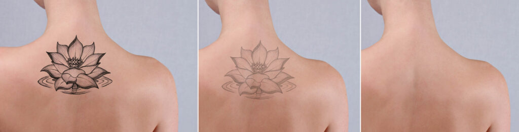 Laser tattoo removal before and after. Beautiful young woman with tattoo on her back