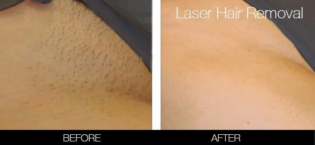 image3_non-surgical_laser-skin-treatmens_bikini-brazilian-laser-hair-removal