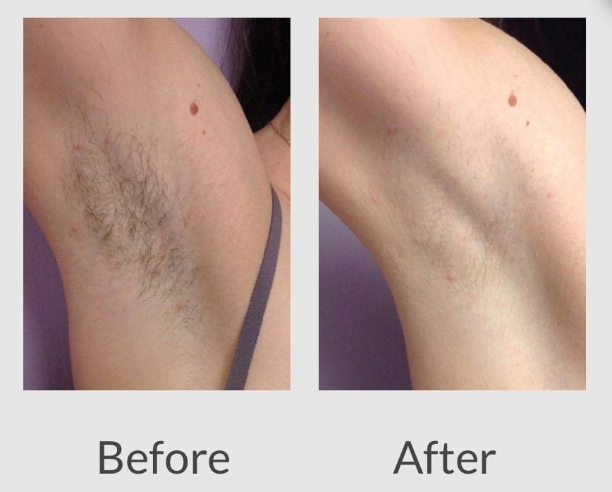 laser-hair-removal-before-after