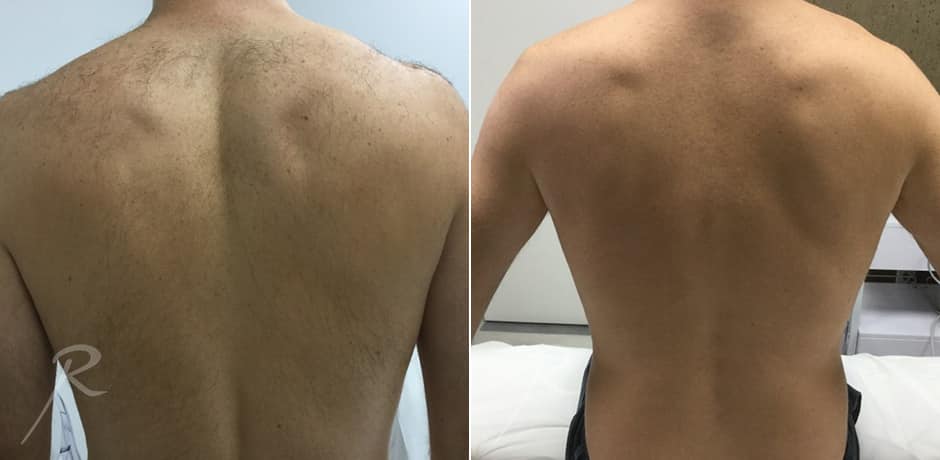 laser-hair-removal-before-and-after-treatment-new-york-1